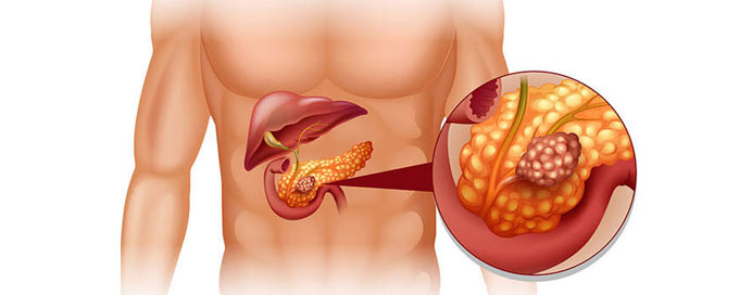 Pancreatic Diseases & Associated Surgery