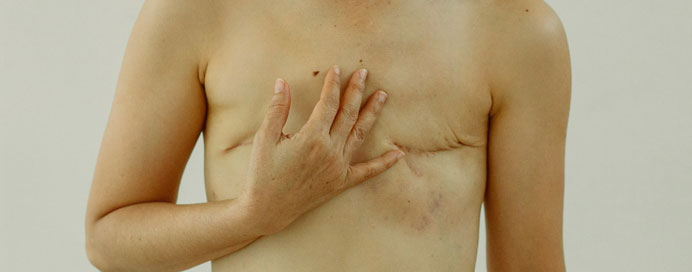 Breast Cancer Surgeries