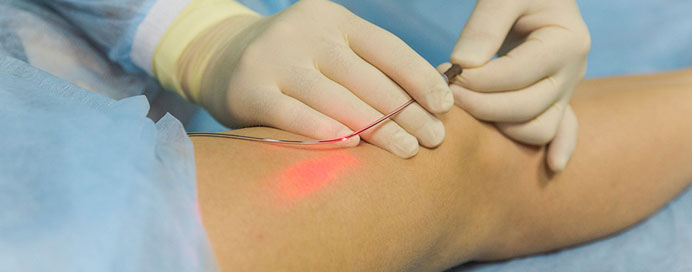 Laser Treatment For Varicose Veins (EVLT)