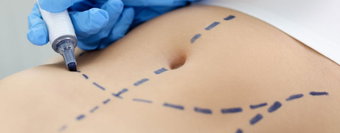 Abdominal Wall Reconstruction