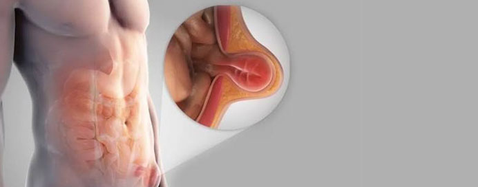 Hernia Surgery