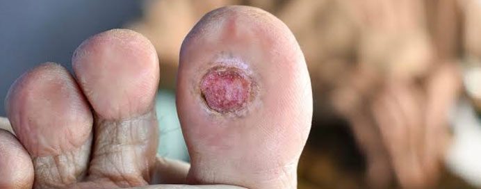 Diabetic Foot Surgery