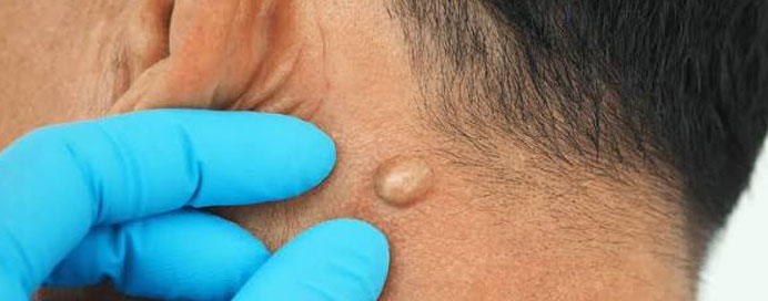Cyst & Lipoma Surgery